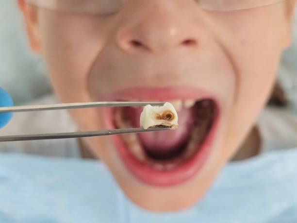 Best Emergency Treatment for Oral Infections in East Douglas, MA
